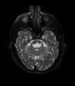 MRI_Central_Pontine_Myelinolysis_fat_sat_T2